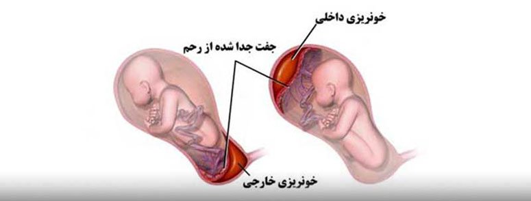 عکس هماتوم در بارداری - هماتوم ساب کوریونیک