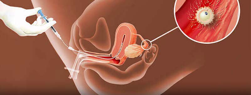 بارداری با آی یو آی (IUI)